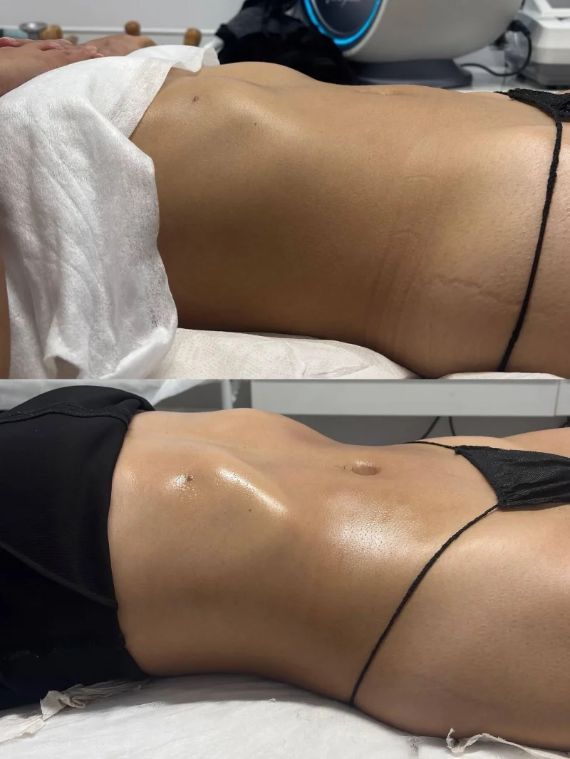 Tratamiento corporal antes y después en JessMara